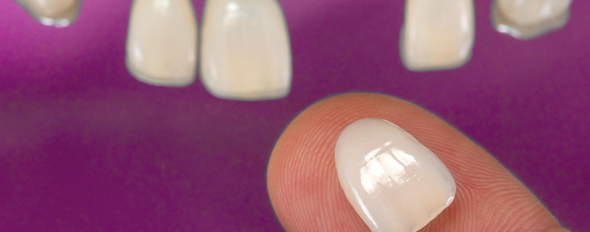 Aufnahme von Veneers auf einer Fingerspitze aus der Zahnarztpraxis Grube Carl in Frechen.