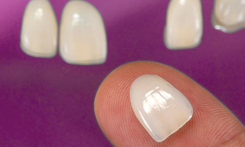 Aufnahme von Veneers aus Frechen auf einer Fingerspitze.