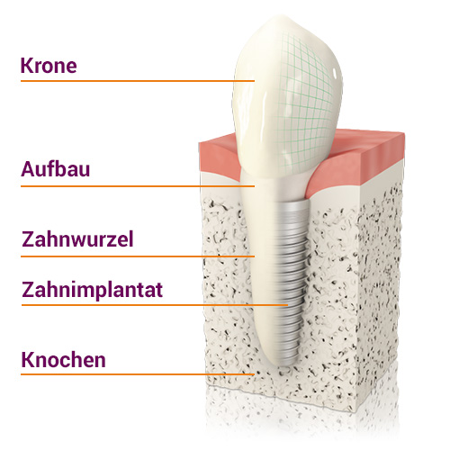 Modell eines Zahnimplantats beim Zahnarzt in Frechen.